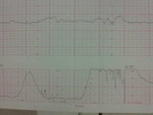 Monitorizaci&oacute;n: arriba, o coraz&oacute;n do feto, e debaixo, as contracci&oacute;ns da nai. Flickr: sd