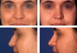 Os resultados dunha rinoplastia, unha das operaci&oacute;ns est&eacute;ticas m&aacute;is estendidas